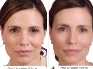 juvederm-voluma-before-after juvederm-voluma-before-after