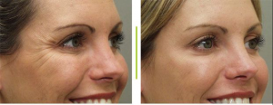 botox1 botox1
