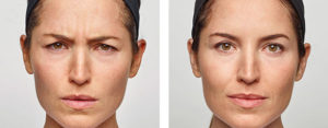 dysport-BeforeAfter-6 dysport-BeforeAfter-6